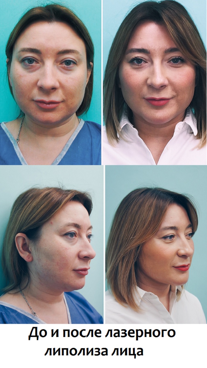 До и после лазерного липолиза лица