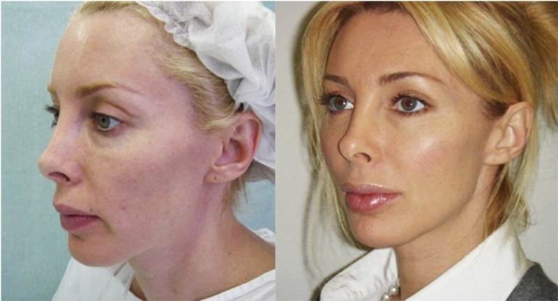 До и после подтяжки лица