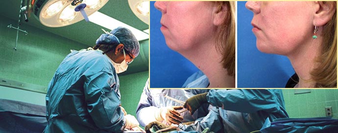 Операция по подтяжки шеи и результат до и после