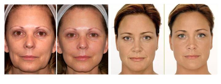 Фото 2-х женщин до и после процедуры рф лифтинга