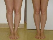 Как можно исправить кривые ноги