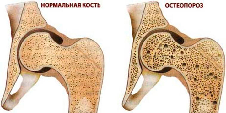Остеопороз - одна из причин вальгусной деформации