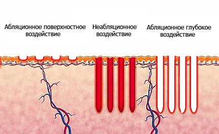Виды фракционного лазерного воздействия на кожу