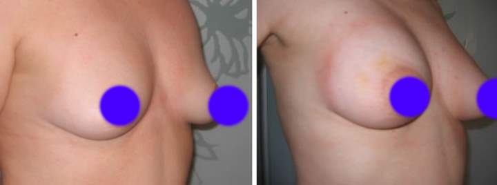 Фото 2 до и после изменения груди