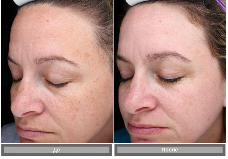 Фраксель - лазерная терапия кожи лица