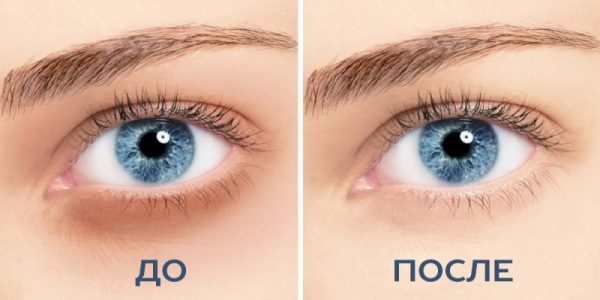 Кожа вокруг глаз до и после косметологической коррекции