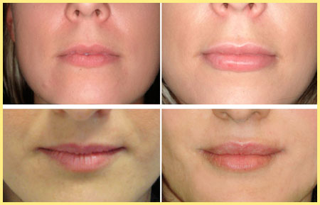 Вид до и после корекции губ гиалуроновой кислотой