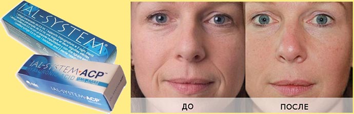 Препараты ial-system до и после омоложение лица