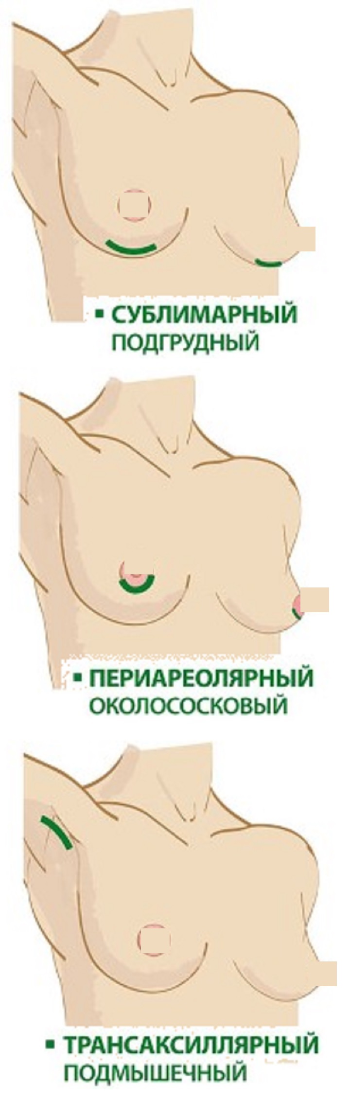 Введение имплантов в грудь