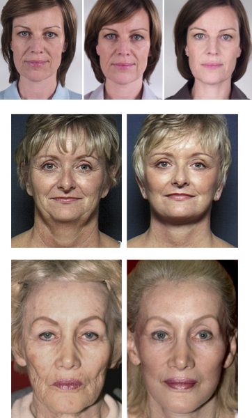 Женщины до и после подтяжки лица