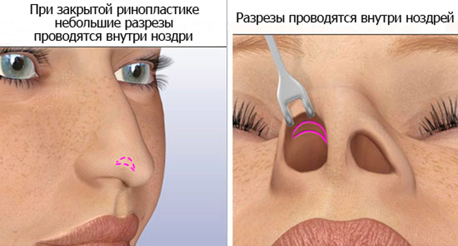Закрытая ринопластика носа
