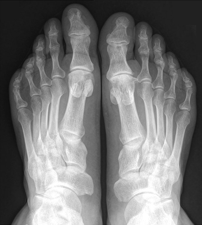 Рентгенография стопы ноги