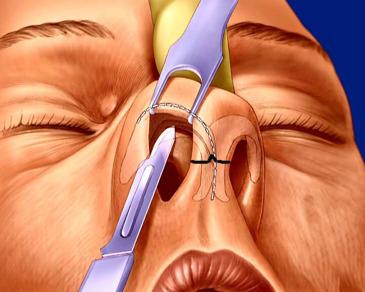 Хирургические методы удаления перфорации носовой перегородки