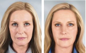 Женщина 45 лет до и после ботокса