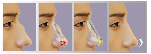 Как убрать горбинку на носу без операции