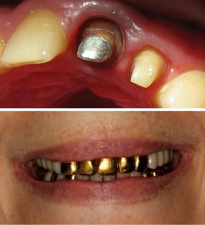 Металл в зубах