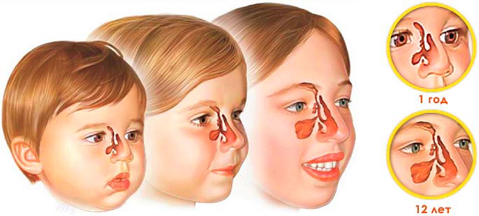 Воспаление гайморовых пазух - результат искривления носовой перегородки