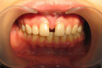 показание к пластики верхней губы: диастема