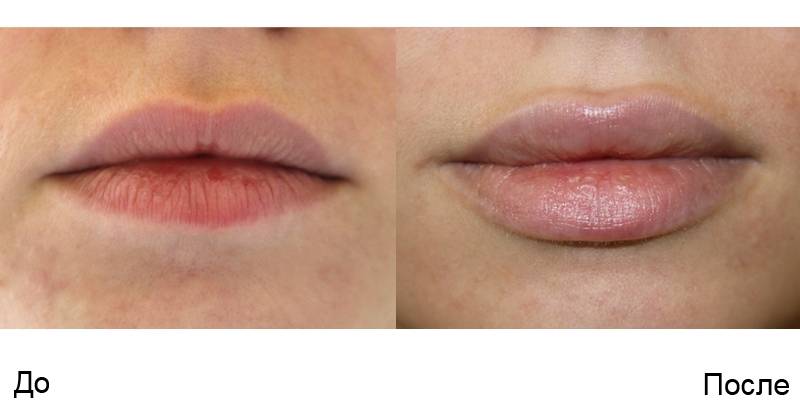 губы до и после увеличения