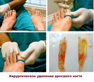 Лечение вросшего ногтя на примере хирургического удаления
