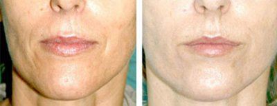 биоревитализация кожи лица фото до и после