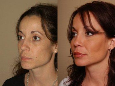 липофилинг лица фото до и после