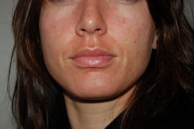 аллергическая реакция на коже лица