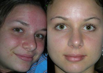 Алмазная дермабразия лица фото до и после