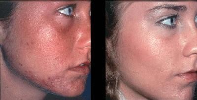 дермабразия лица фото до и после
