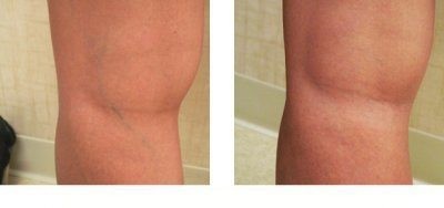 лечение вен на ногах фото до и после