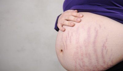 растяжки при беременности на животе